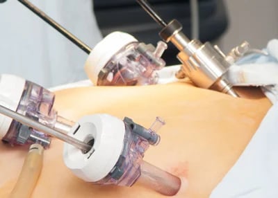 So finden Sie die Magenverkleinerung Türkei Beste Klinik für optimale Ergebnisse