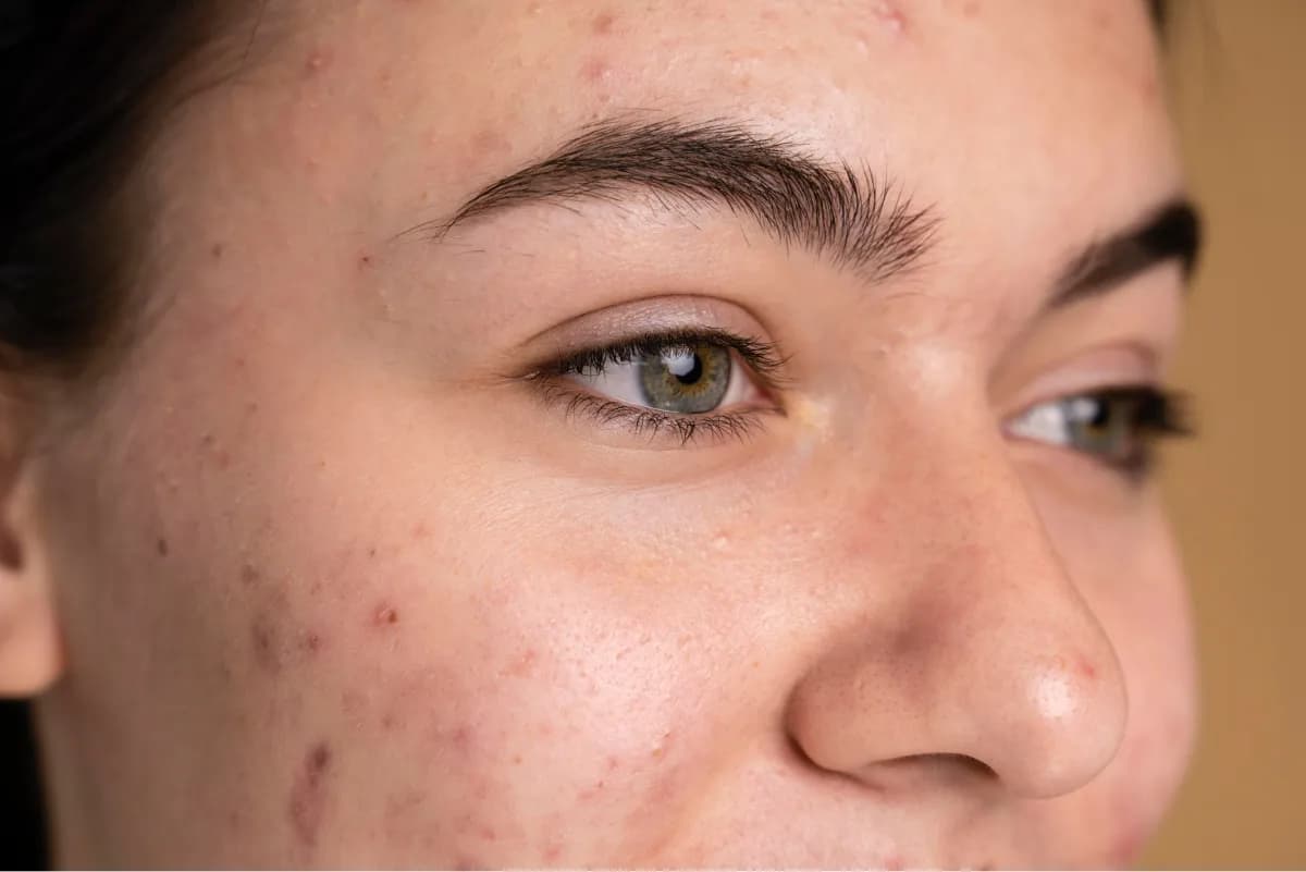 Acne Treattreatment – Effective Solutions for Clear, Confident Skin