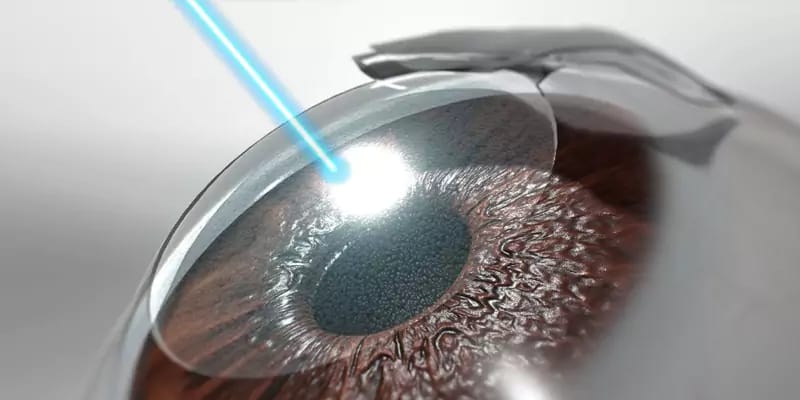 Achieving Clear Vision: The Definitive Guide to lasik turkey