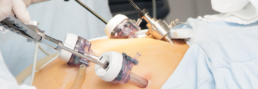 So finden Sie die Magenverkleinerung Türkei Beste Klinik für optimale Ergebnisse