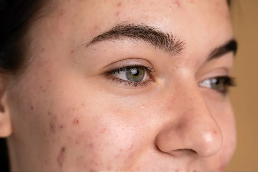 6337ccfb9be54a6a481f1a85_young woman with acne up close (1)