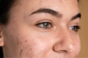 6337ccfb9be54a6a481f1a85_young woman with acne up close (1)